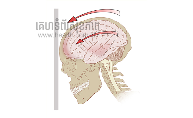 ការរបួសនៅលើខួរក្បាលអាចមានអាការៈ…