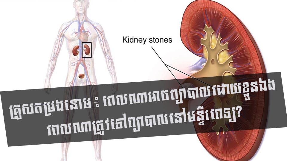 គ្រួសតម្រងនោម ៖ ពេលណាអាចព្យាបាលដោយខ្លួនឯង ពេលណាត្រូវទៅព្យាបាលនៅមន្ទីរពេទ្យ?