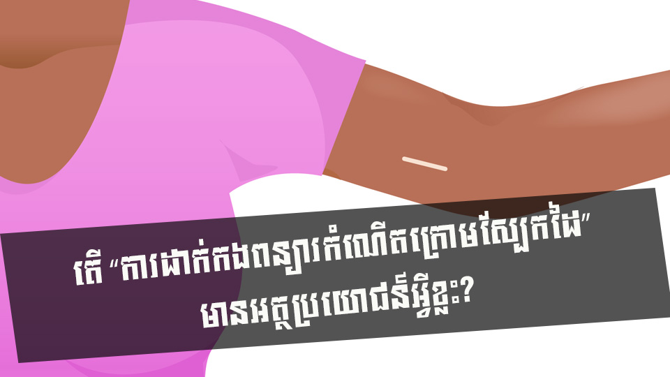តើ “ការដាក់កងពន្យារកំណើតក្រោមស្បែកដៃ” មានអត្ថប្រយោជន៍អ្វីខ្លះ?