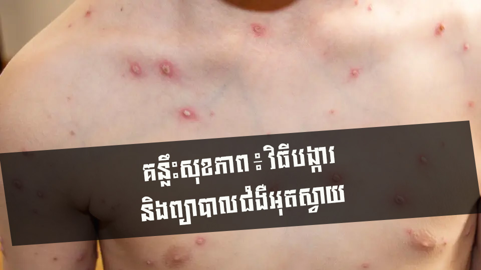 គន្លឹះសុខភាព ៖ វិធីបង្ការ និងព្យាបាលជំងឺអុតស្វាយ