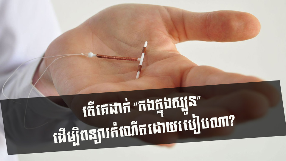 តើគេដាក់ “កងក្នុងស្បូន” ដើម្បីពន្យារកំណើតដោយរបៀបណា?