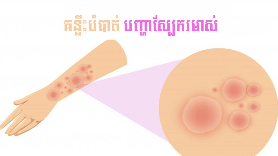 គន្លឹះសុខភាព ៖ គន្លឹះបំបាត់បញ្ហាស្បែករមាស់