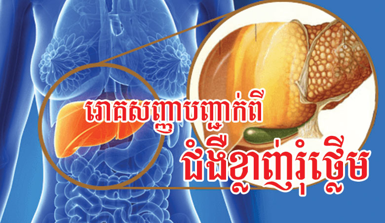 ជំងឺខ្លាញ់រុំថ្លើមស្តាប់ទៅគួរឲ្យខ្លាច មានដឹងថាវាមានរោគសញ្ញាអ្វីខ្លះទេ?