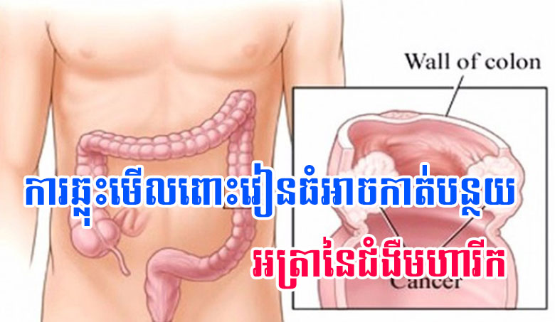 ការឆ្លុះមើលពោះវៀនធំអាចកាត់បន្ថយអត្រានៃជំងឺមហារីក
