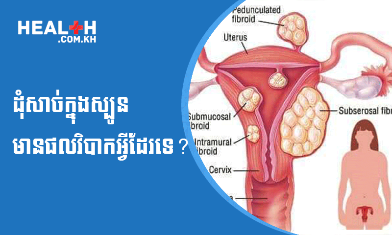 ដុំសាច់ក្នុងស្បូនមានផលវិបាកអ្វីដែរទេ?