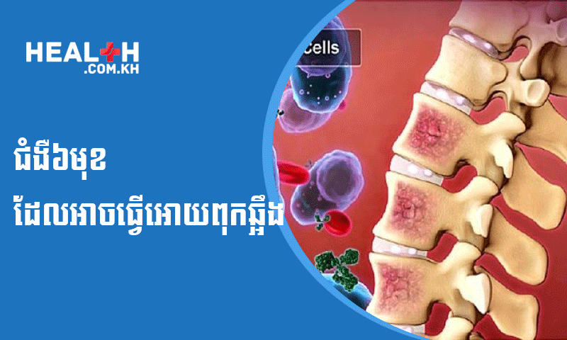 ជំងឺ៦មុខដែលអាចធ្វើអោយពុកឆ្អឹង