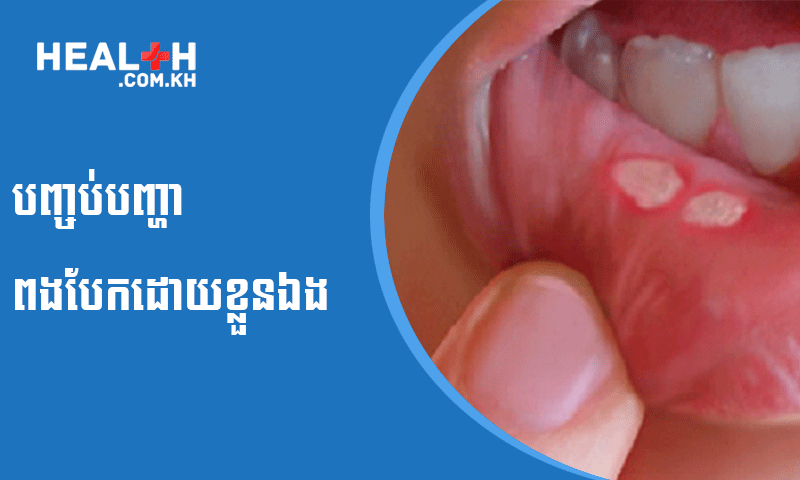 បញ្ចប់បញ្ហាពងបែកដោយខ្លួនឯង 