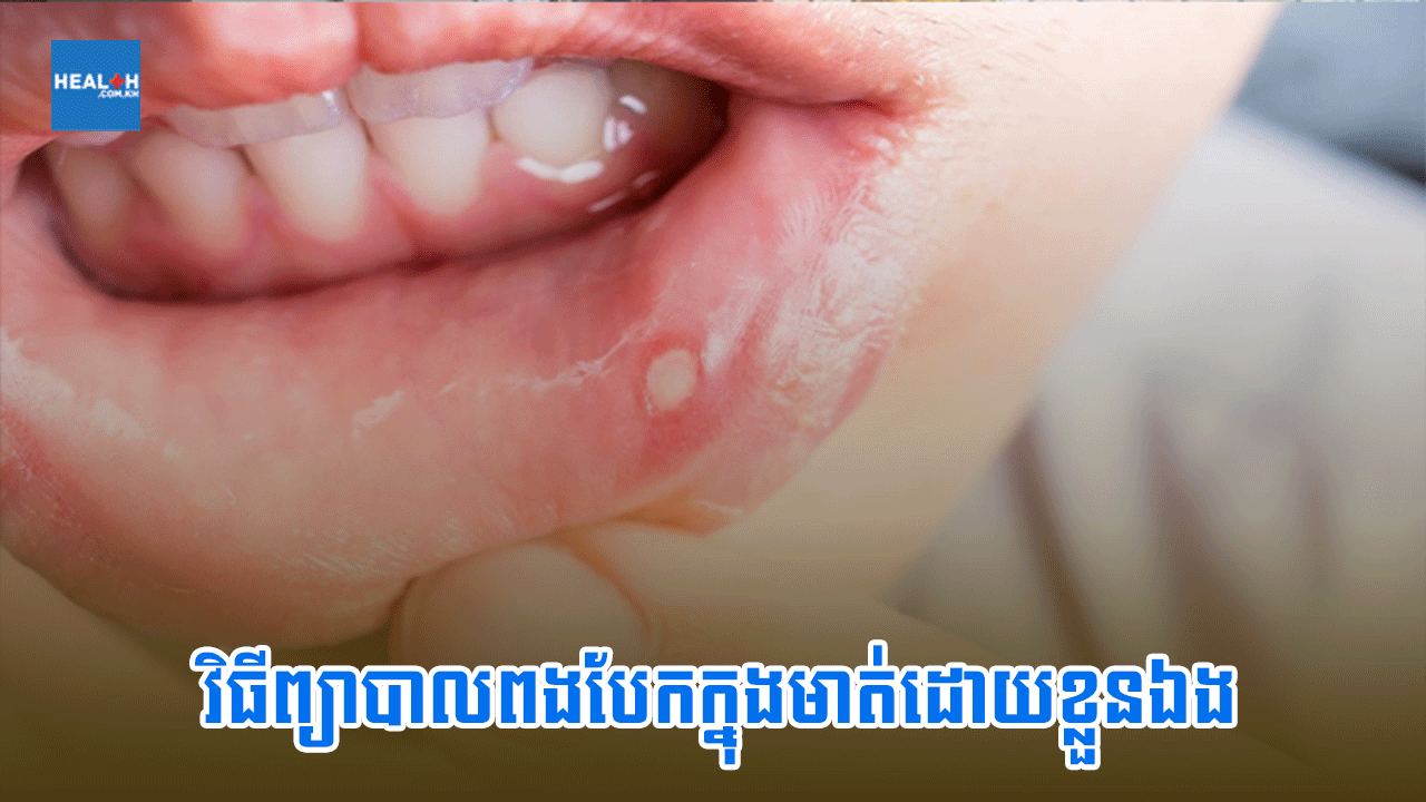 វិធីព្យាបាលពងបែកក្នុងមាត់ដោយខ្លួនឯង