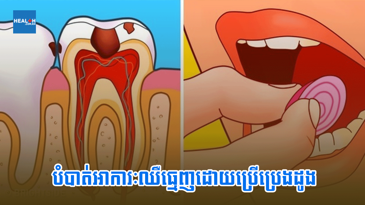 បំបាត់អាការៈឈឺធ្មេញដោយប្រើប្រេងដូង