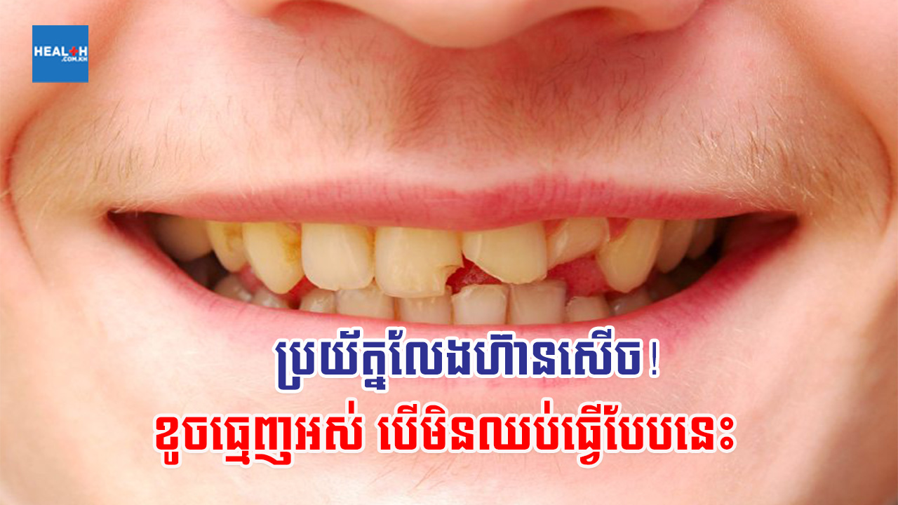 ប្រយ័ត្នលែងហ៊ានសើច! មិនចង់ខូចធ្មេញ កុំធ្វើបែបនេះទៀត