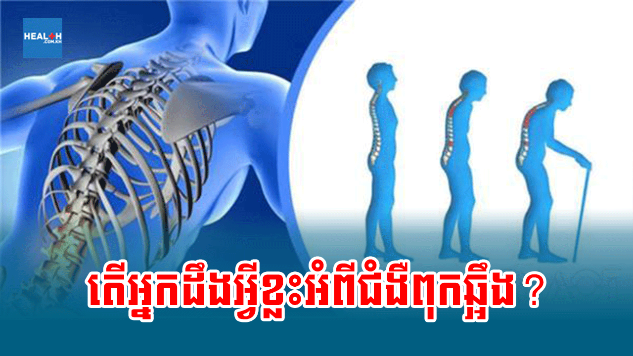 តើអ្នកដឹងអ្វីខ្លះអំពីជំងឺពុកឆ្អឹង?