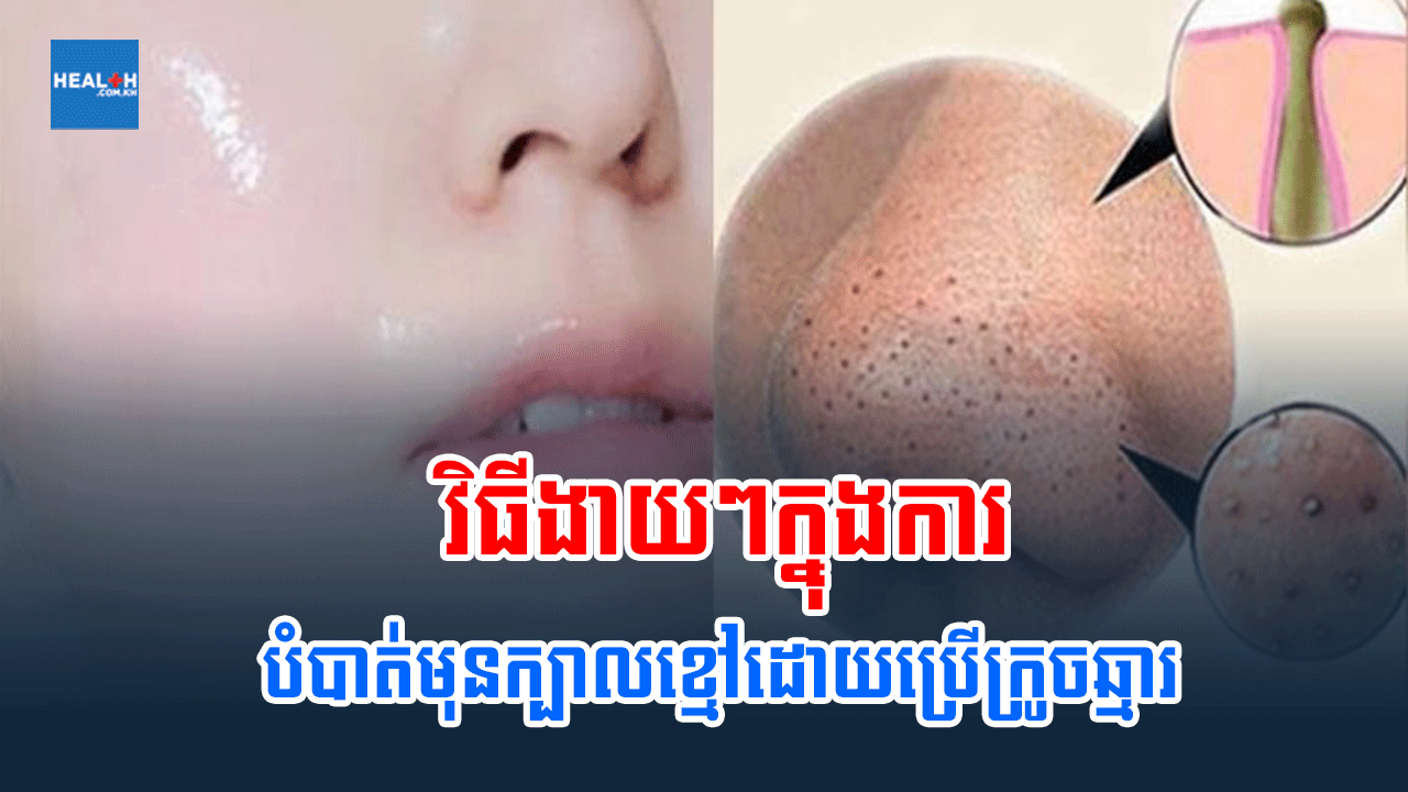វិធីងាយៗក្នុងការបំបាត់មុនក្បាលខ្មៅដោយប្រើក្រូចឆ្មារ