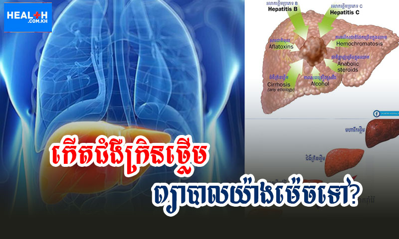 កើតជំងឺក្រិនថ្លើមព្យាបាលយ៉ាងម៉េចទៅ?