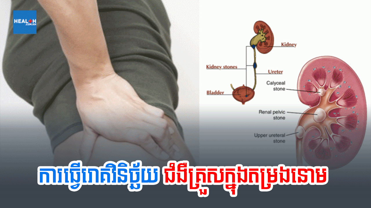 ការធ្វើរោគវិនិច្ឆ័យជំងឺគ្រួសក្នុងតម្រងនោម
