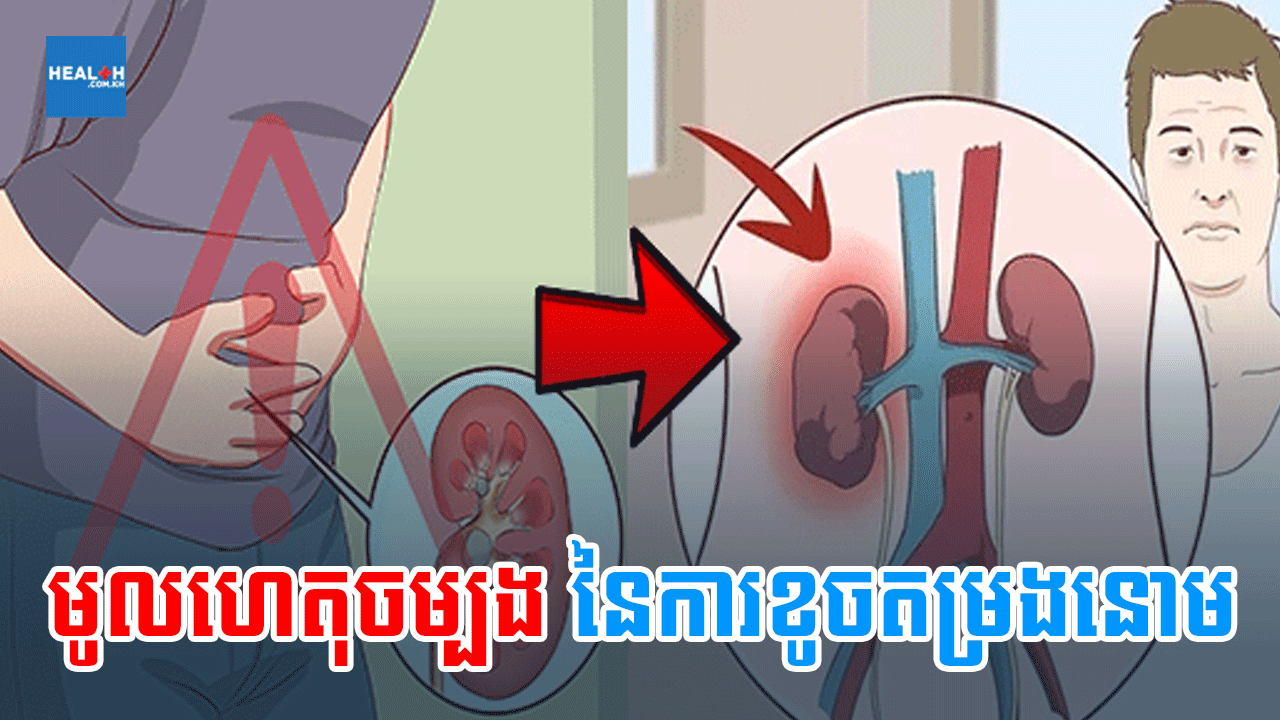តើអ្វីជាមូលហេតុចម្បងនៃការខូចតម្រងនោម?