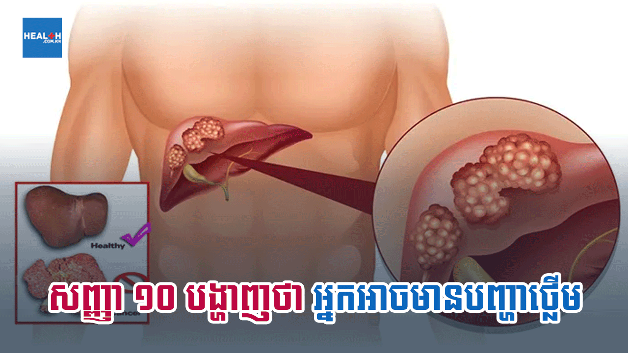 សញ្ញា ១០បង្ហាញថាអ្នកអាចមានបញ្ហាថ្លើម