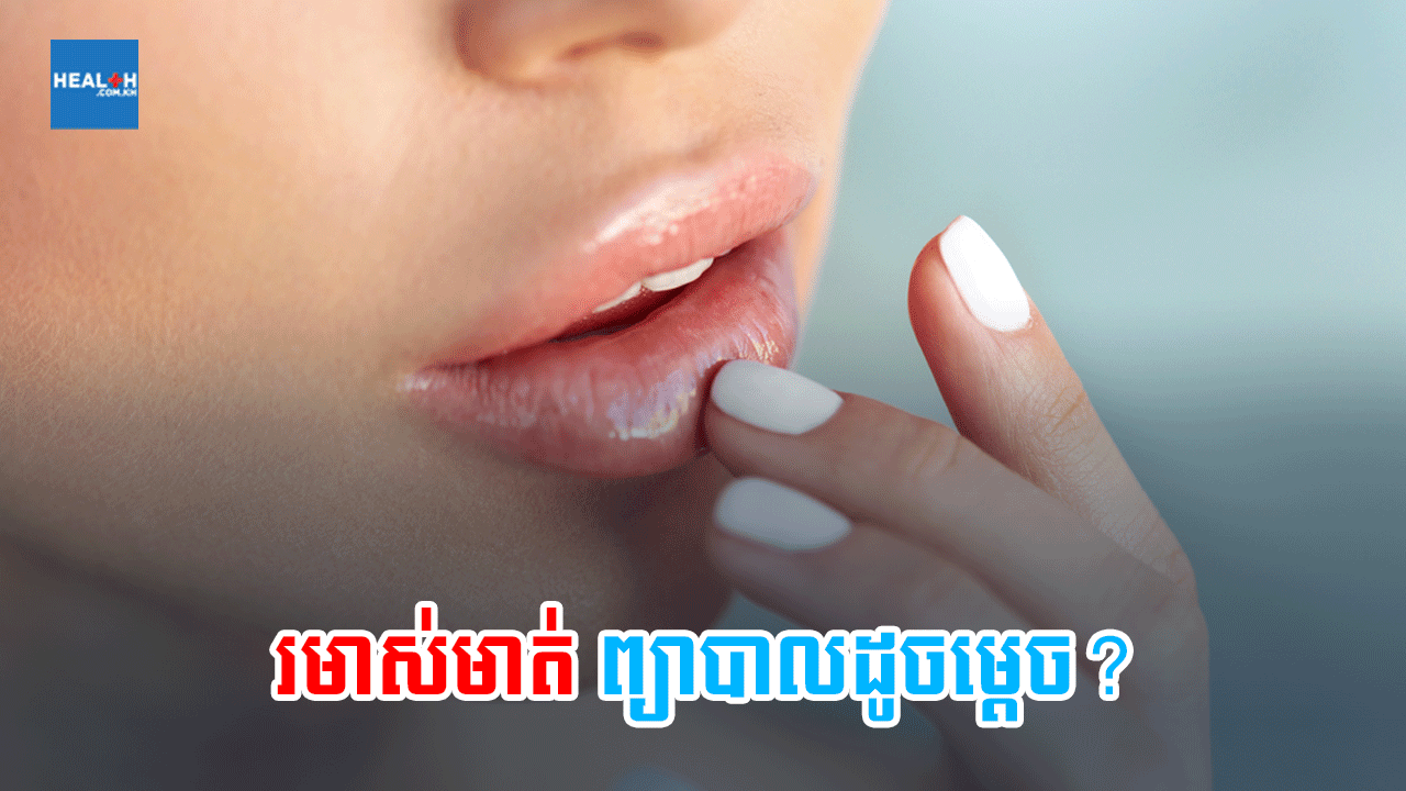 រមាស់មាត់ ព្យាបាលដូចម្តេច?