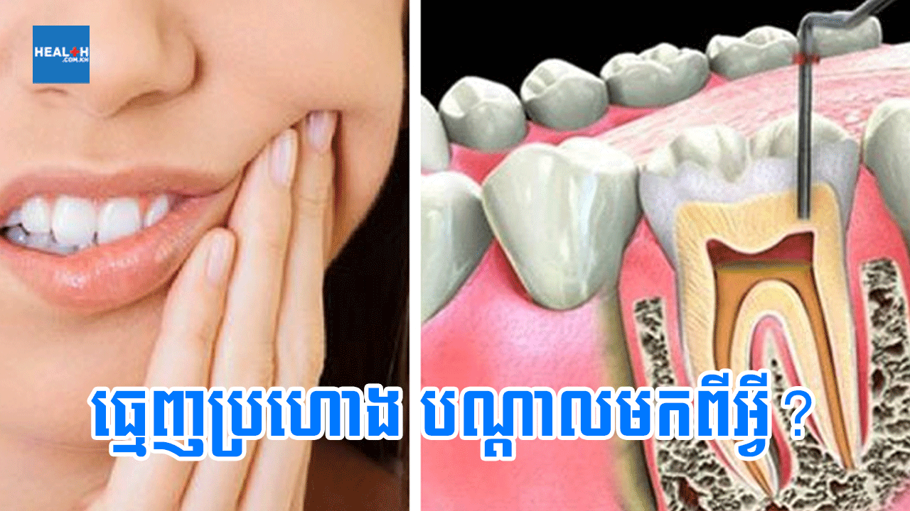 ធ្មេញប្រហោង បណ្តាលមកពីអ្វី?