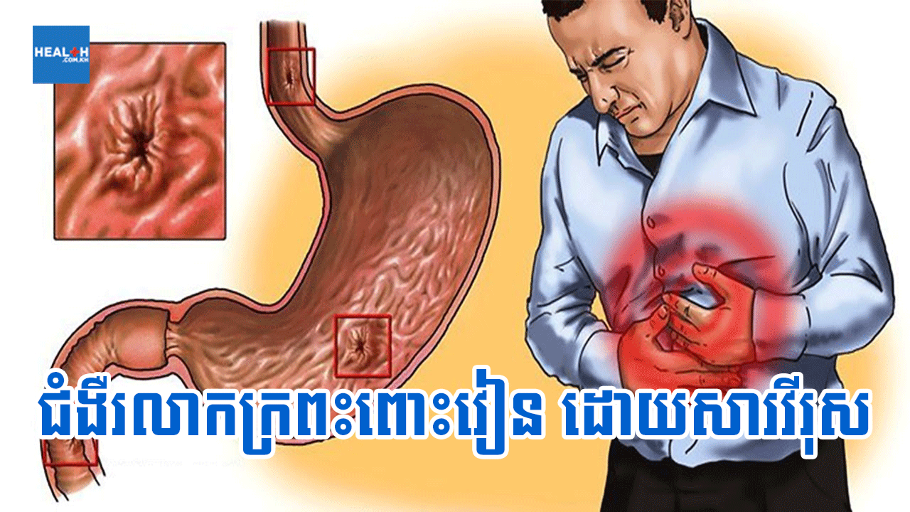 ជំងឺរលាកក្រពះពោះវៀន ដោយសារវីរុស