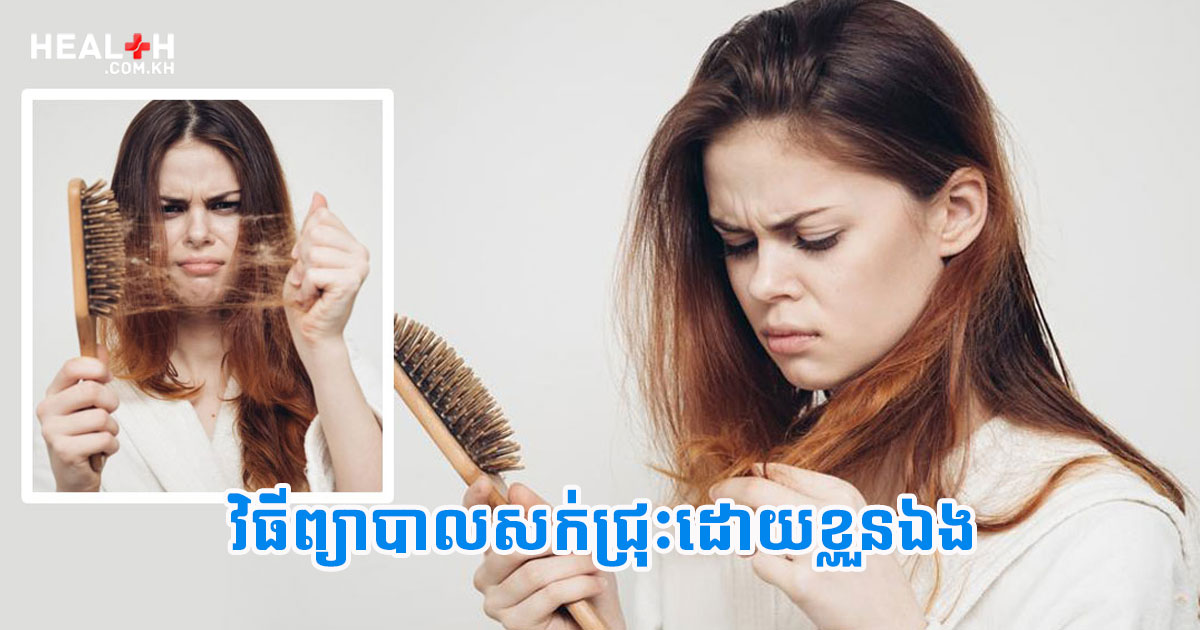 វិធីព្យាបាលសក់ជ្រុះដោយខ្លួនឯង