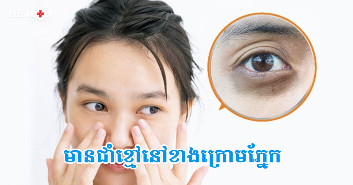 មានជាំខ្មៅនៅខាងក្រោមភ្នែក