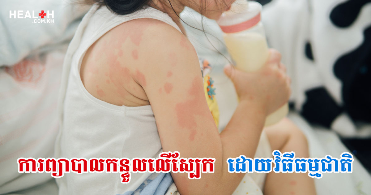 ការព្យាបាលកន្ទួលលើស្បែកដោយវិធីធម្មជាតិ