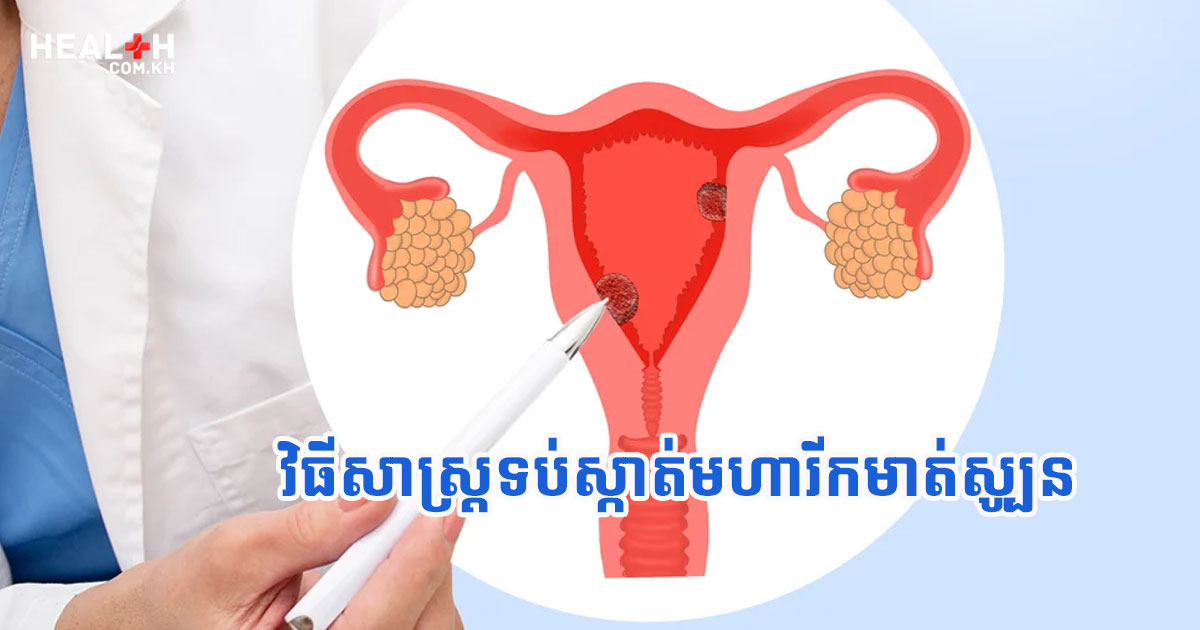 ដំបូន្មានទប់ស្កាត់មហារីកមាត់ស្បូន