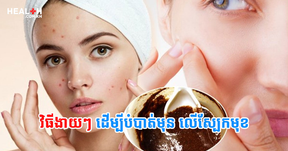 វិធីងាយៗ ដើម្បីបំបាត់មុន លើស្បែកមុខ