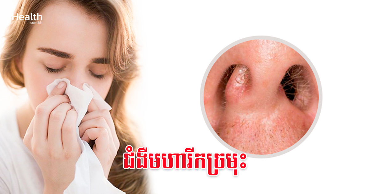 ជំងឺមហារីកច្រមុះ