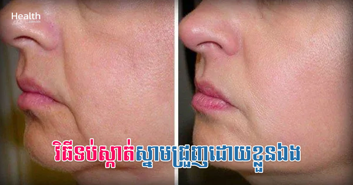 វិធីទប់ស្កាត់ស្នាមជ្រួញដោយខ្លួនឯង