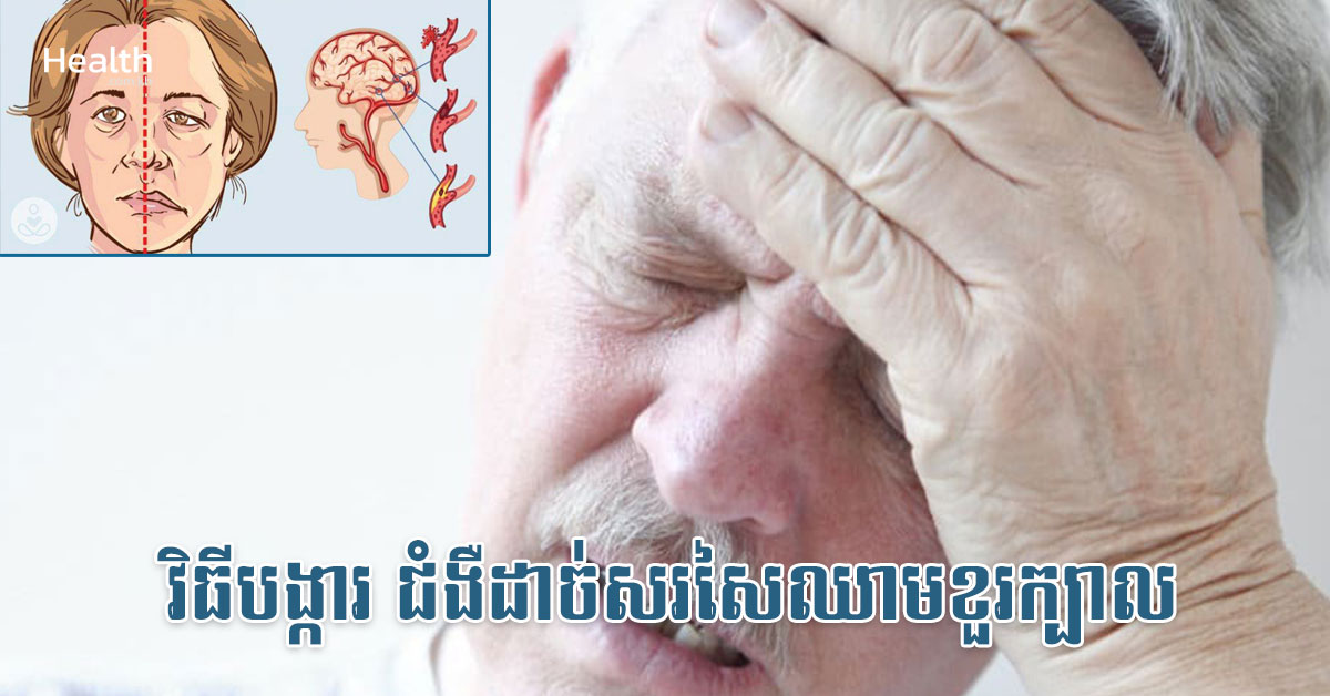 វិធីបង្ការ ជំងឺដាច់សរសៃឈាមខួរក្បាល