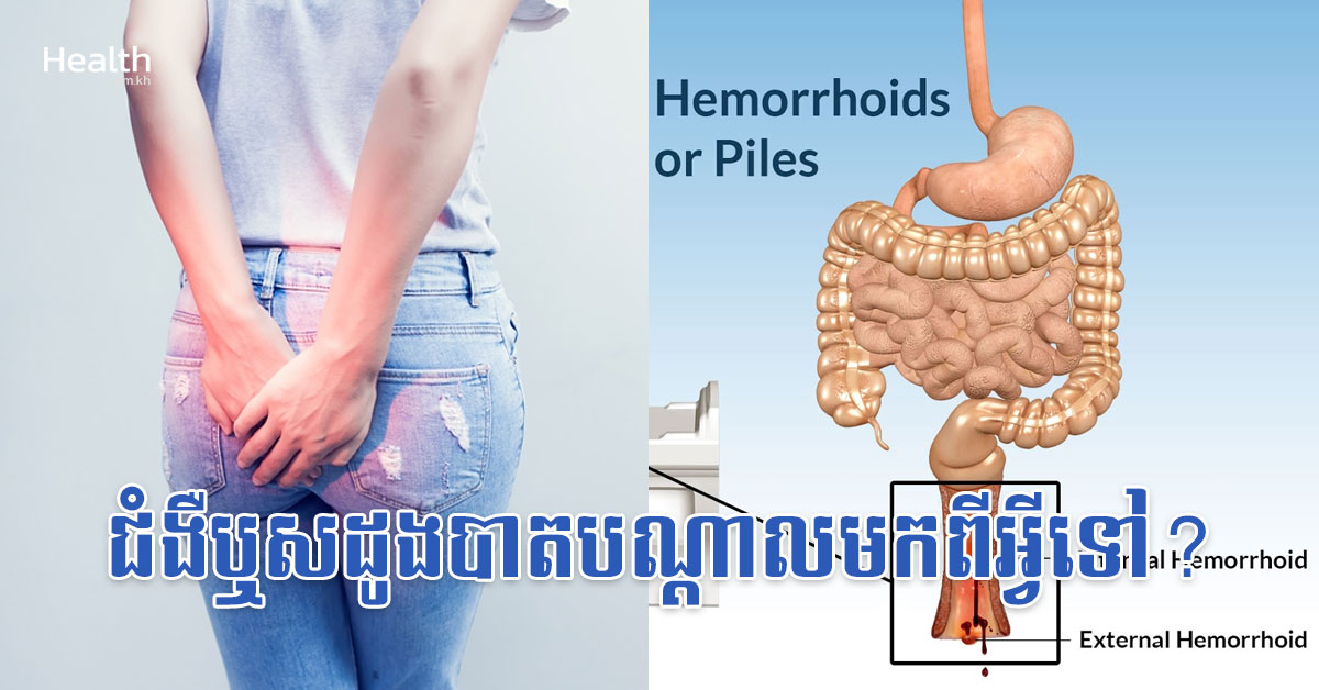 ជំងឺឬសដូងបាតបណ្តាលមកពីអ្វីទៅ?
