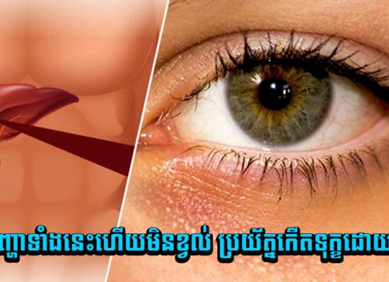 គ្រោះថ្នាក់ណាស់ បើចេញសញ្ហាទាំងនេះហើយមិនខ្វល់ ប្រយ័ត្នកើតទុក្ខដោយជំងឺថ្លើម