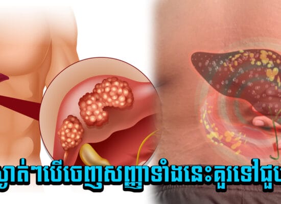 គ្រោះថ្នាក់ ! មហារីកថ្លើមកើតស្ងាត់ៗ តែបើចេញសញ្ញាទាំងនេះគួរទៅជួបពេទ្យ