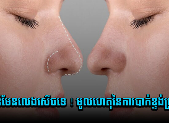 មិនមែនលេងសើចទេ ! មូលហេតុនៃការបាក់ខ្ទង់ច្រមុះ