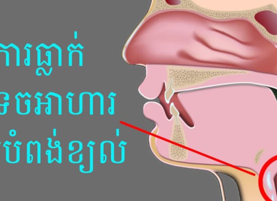 វិបត្តិនៃការហូបអាហារលើអ្នកជំងឺស្ទះ ឬដាច់សរសៃឈាមខួរក្បាល ៖ តើត្រូវពិសាអាហារ និងទឹកយ៉ាងដូចម្តេច?