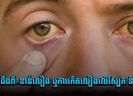 តិចអត់ដឹងពី«ខាន់លឿង ឬការកើតលឿងលើស្បែក និងភ្នែក»