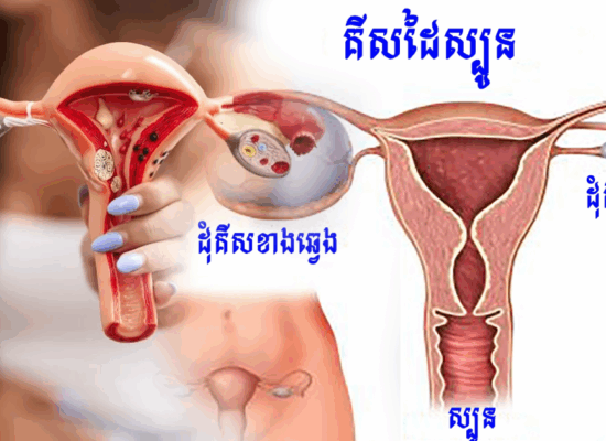 ប្រុងប្រយ័ត្ន! ដុំគីសដៃស្បូន ដែលកើតលើស្ត្រីចំណាស់ ក្រោយពេលអស់រដូវ អាចក្លាយជាមហារីក