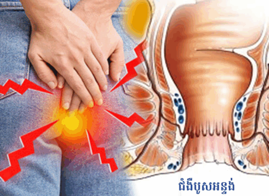 មិនគួររំមើលរំលង! ទាំងនេះជារោគសញ្ញា និងផលវិបាកនៃជំងឺបូសអន្ទង់