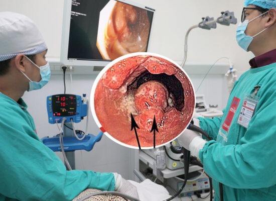 មហារីកបំពង់អាហារ ៖ ការវិវត្តនៃដុំសាច់ កត្តាប្រឈម និងរោគសញ្ញាសំខាន់ៗ