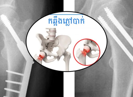 ការបាក់កឆ្អឹងភ្លៅ ៖ គ្រោះថ្នាក់ធ្ងន់ធ្ងរដែលគំរាមកំហែងដល់អាយុជីវិតមនុស្សចាស់